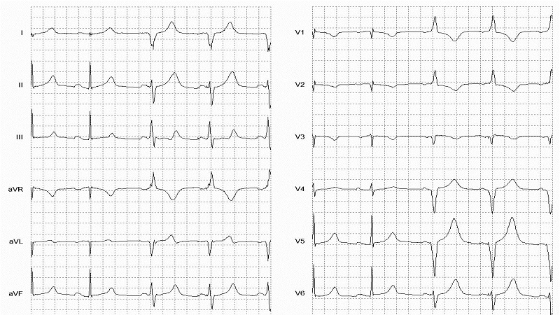 Ventricular Paced (RBB morphology) 62 BPM